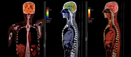 Nuclear Scans