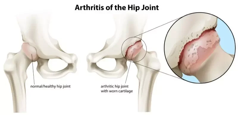 HIP CONDITIONS